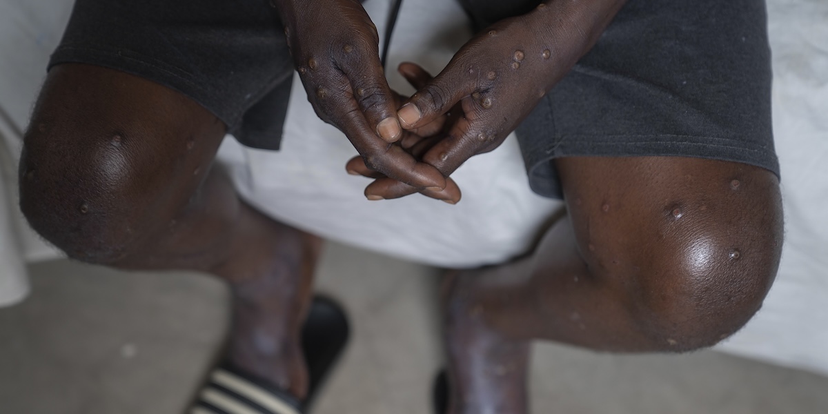 Le mani e le gambe di un uomo con un'infezione da mpox: si vedono delle eruzioni cutanee sulla sua pelle